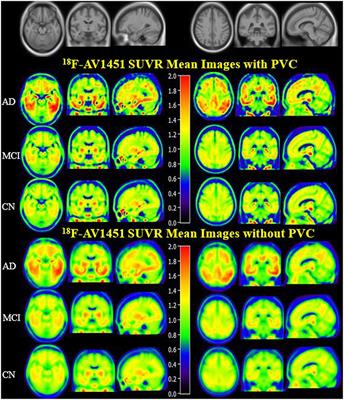 Quantitative 18F-AV1451 Brain Tau PET Imaging in Cognitively Normal Older Adults, Mild Cognitive Impairment, and Alzheimer's Disease Patients